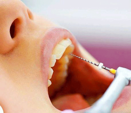 endodoncia-tenerife dentista en tenerife clinica dental tenerife