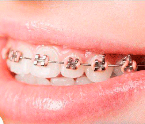 ortodoncia-tenerife en clinica dental tenerife