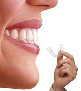 ortodoncia-invisible-invisalign-tenerife