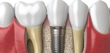 Anatomy of healthy teeth and tooth dental implant in human dentura. 3d illustration